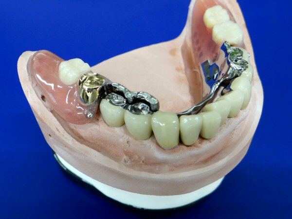 被せと義歯をかけるタイプ